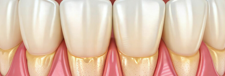 dechaussement des dents