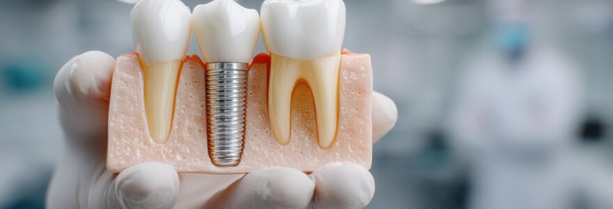 implants dentaires